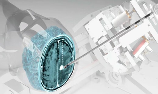 国家专项新突破！中国团队自主研发核磁兼容手术机器人，实现亚毫米级精度！